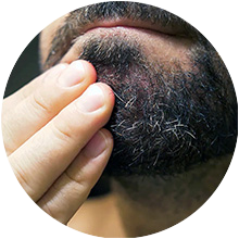 DRY BEARD