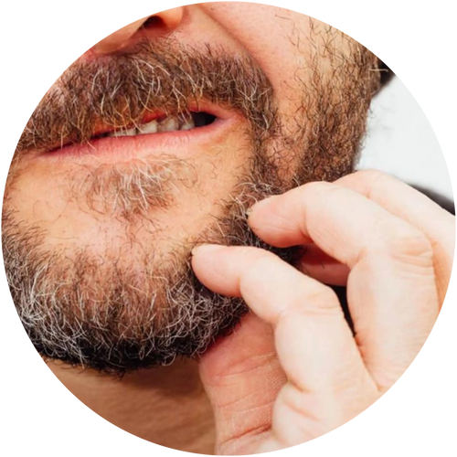 Beard itch