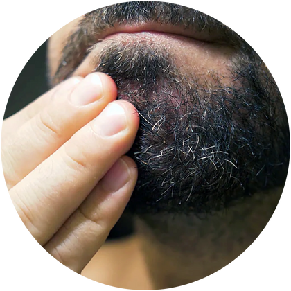 DRY BEARD