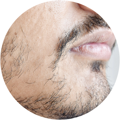 PATCHY BEARD