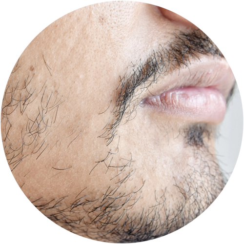 Patchy beard
